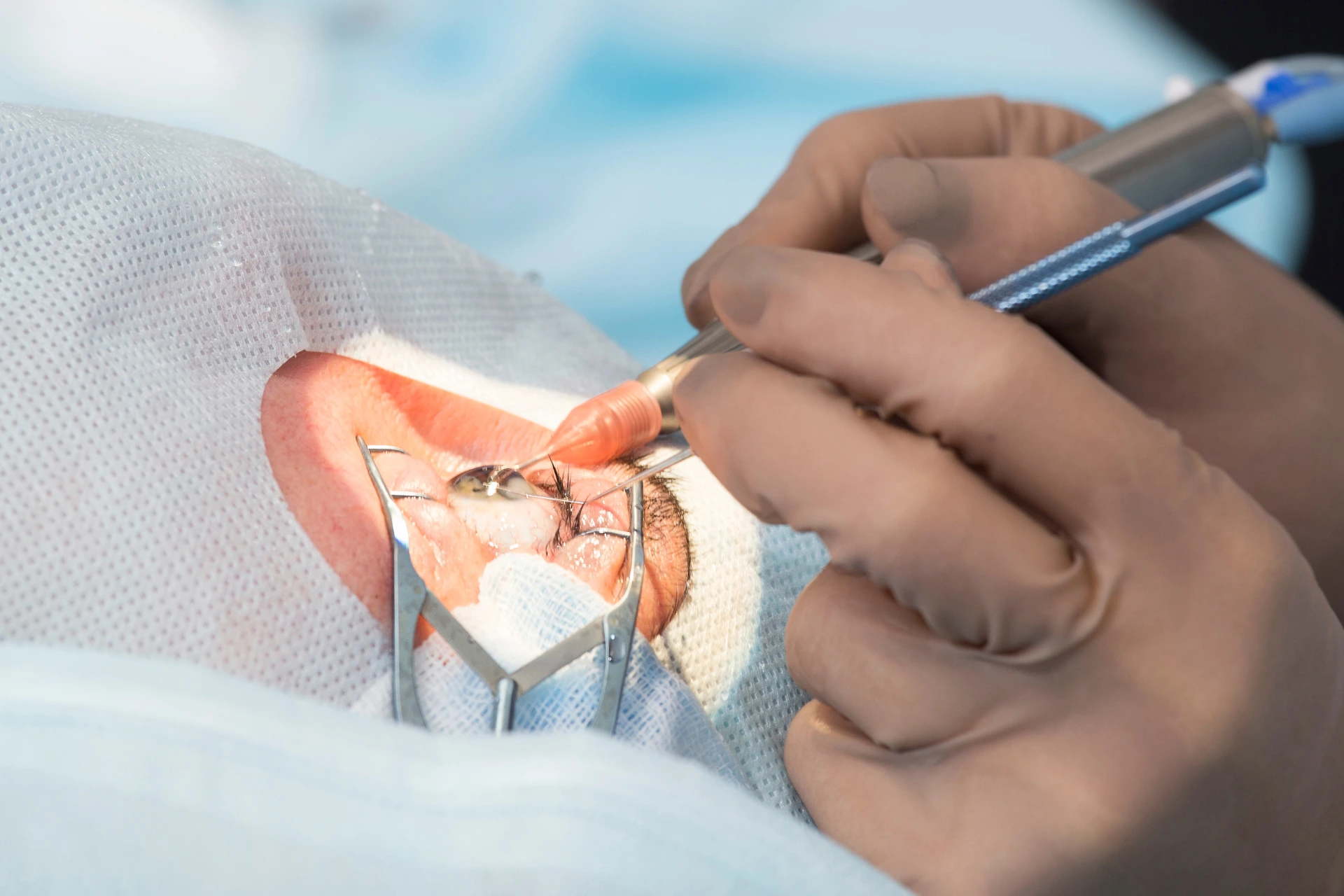 Phacoemulsification